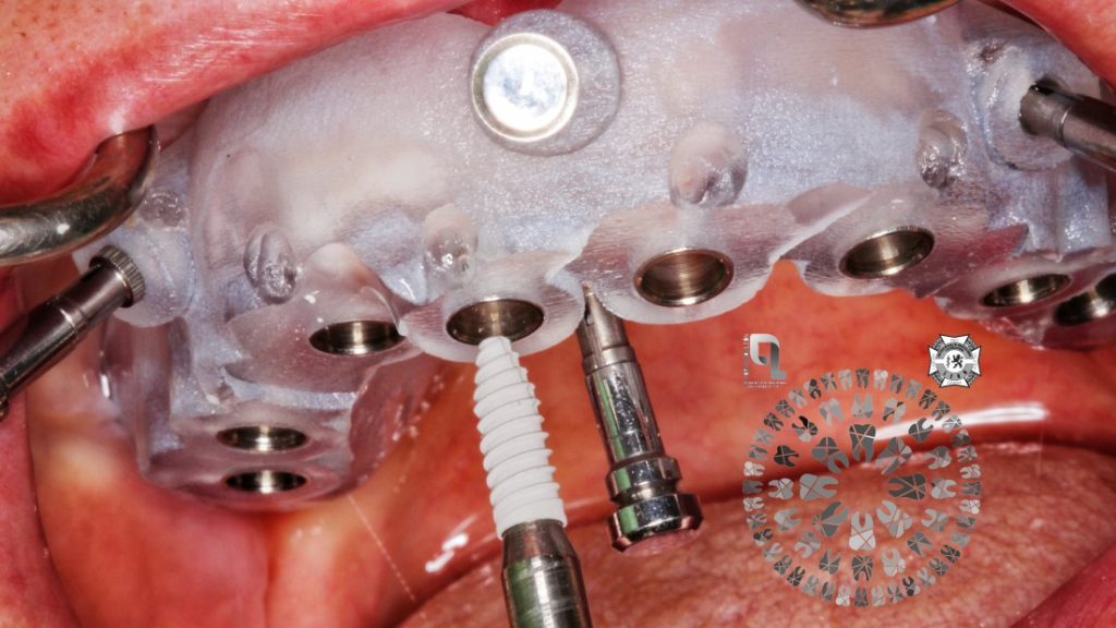 Insercion-de-los-implantes-cirugia-guiada-1